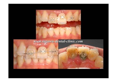 早期埋入の術前術後イメージ例3（田川歯科）